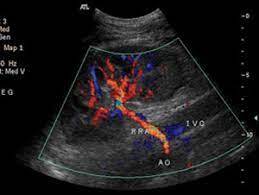 DOPPLER DE ARTÉRIAS RENAIS
