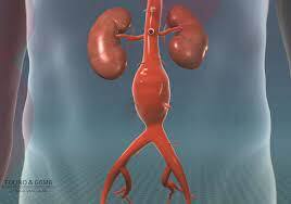 DOPPLER DE AORTA E ILIACAS