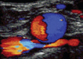 DOPPLER DA ARTÉRIA E VEIA ILÍACA