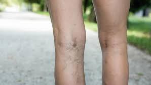 DOPPLER VENOSO DE MEMBROS INFERIORES - MAPEAMENTO