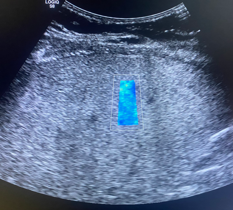 ELASTOGRAFIA HEPÁTICA POR ULTRASSOM