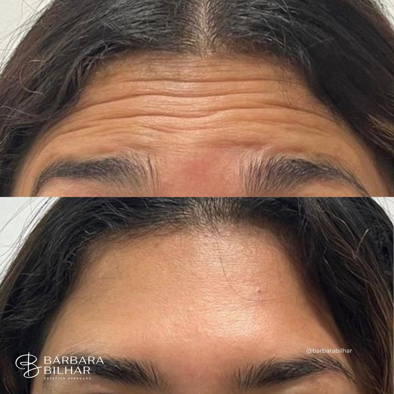 Toxina Botulínica para Rugas da testa