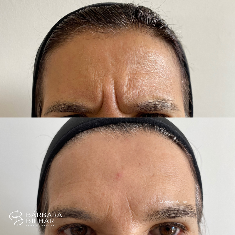 Toxina Botulínica para Rugas da glabela ("ruga de bravo")