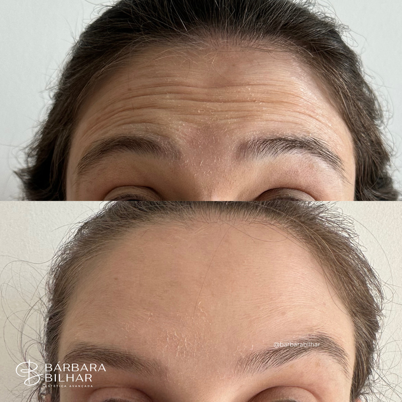 Toxina Botulínica para Rugas da testa