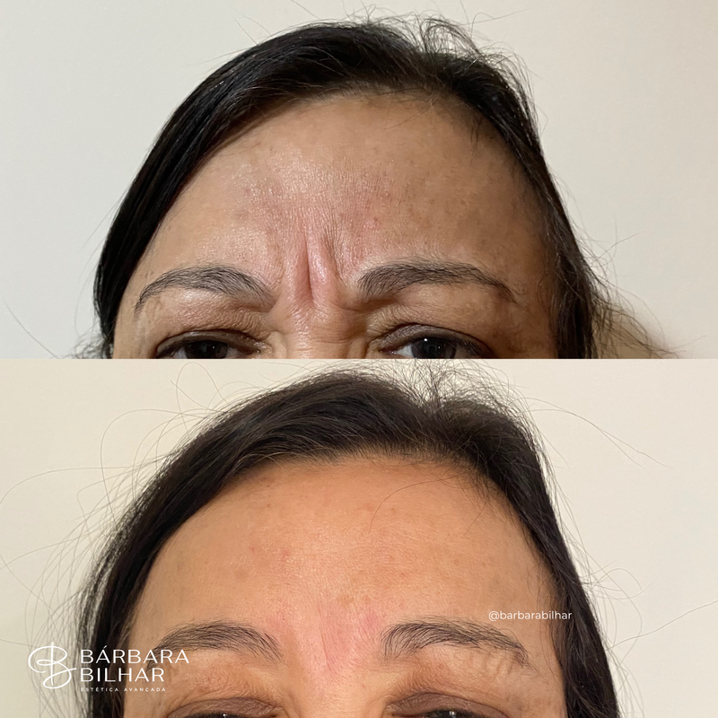 Toxina Botulínica para Rugas da glabela ("ruga de bravo")