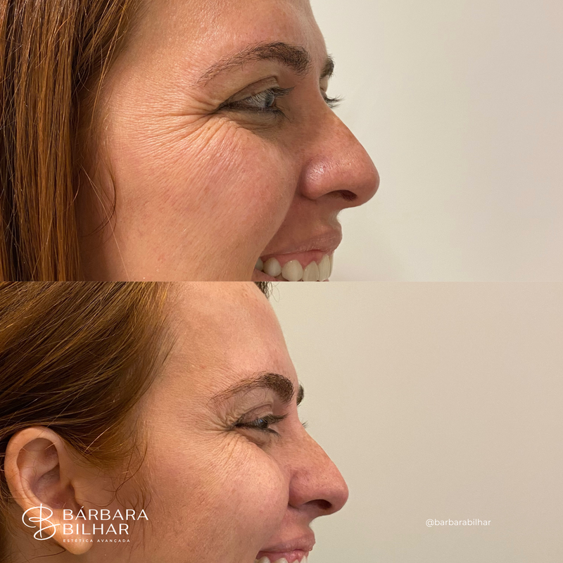 Toxina Botulínica para Rugas da região dos olhos ("pés de galinha")