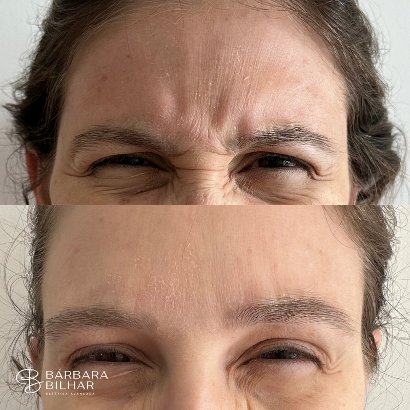 Toxina Botulínica para Rugas do nariz (“bunny lines”)