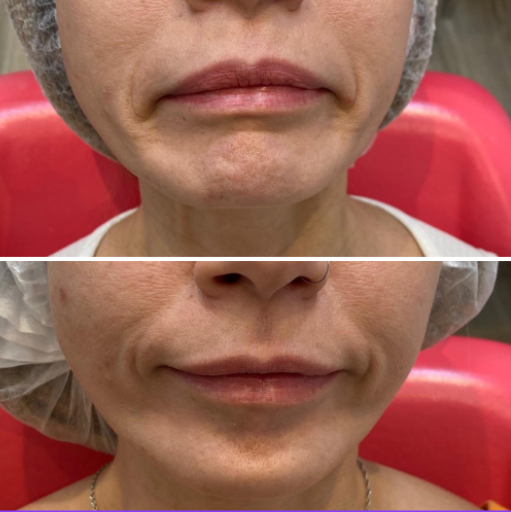 Toxina Botulínica para Queda do canto da boca ("linha de marionete")