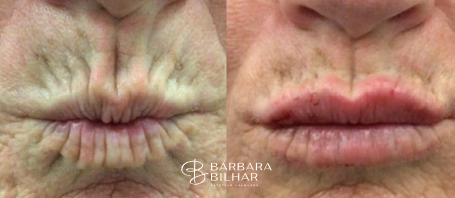 Toxina Botulínica para Rugas periorais ("código de barras")