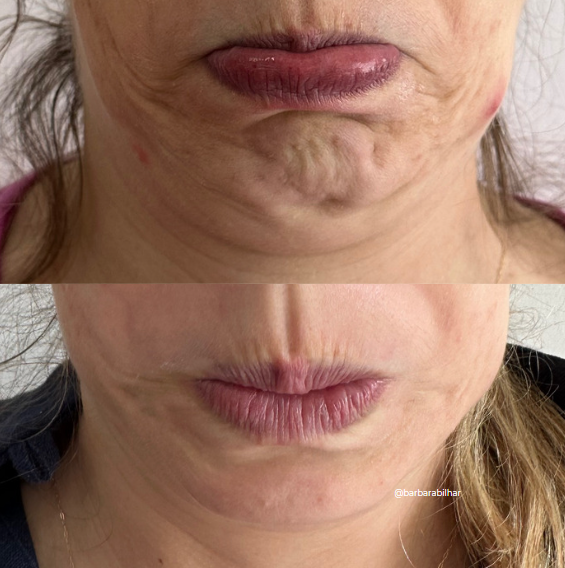 Toxina Botulínica para Queixo ("queixo celulítico")