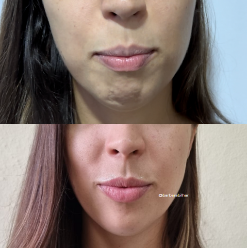 Toxina Botulínica para Queixo ("queixo celulítico")