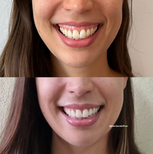 Toxina Botulínica para Sorriso gengival