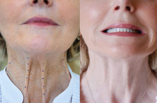 Toxina Botulínica para Efeito Nefertiti (Pescoço)