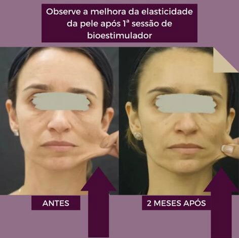 Bioestimuladores de Colágeno