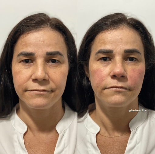 Preenchimento “Top model look” (malar)