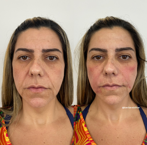 Preenchimento do "Bigode chinês“ (Sulco nasogeniano)