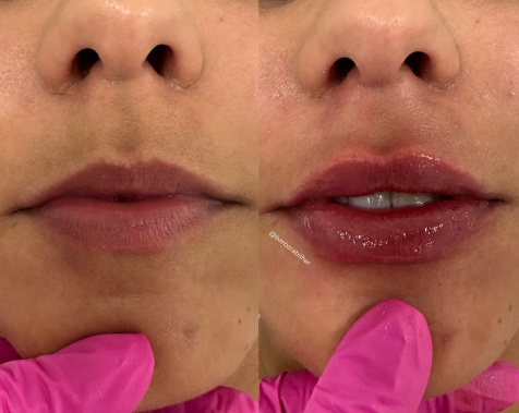 Preenchimento Labial