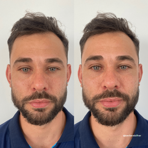 Preenchimento de Mandíbula