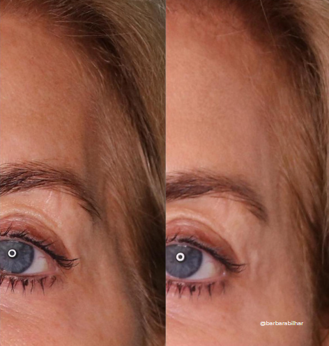 Preenchimento Têmpora