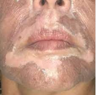 Peeling de retração