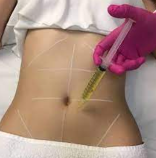 Lipoenzimática de alta definição