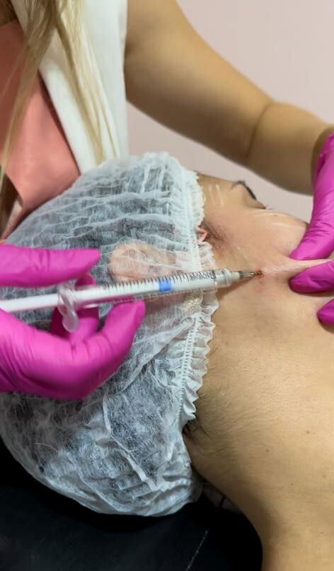 Bioestimuladores de Colágeno