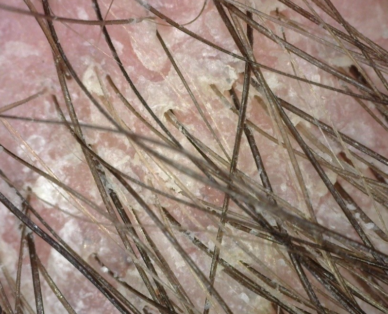 Avaliação com Tricoscópio