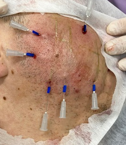 Bioestimulador de Colágeno e Fios de PDO