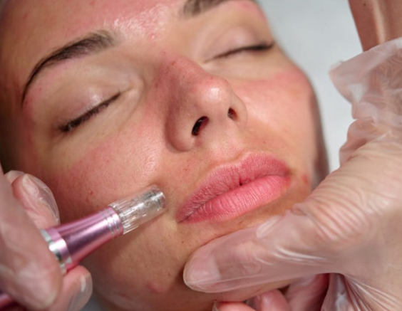 Microagulhamento com Drug Delivery