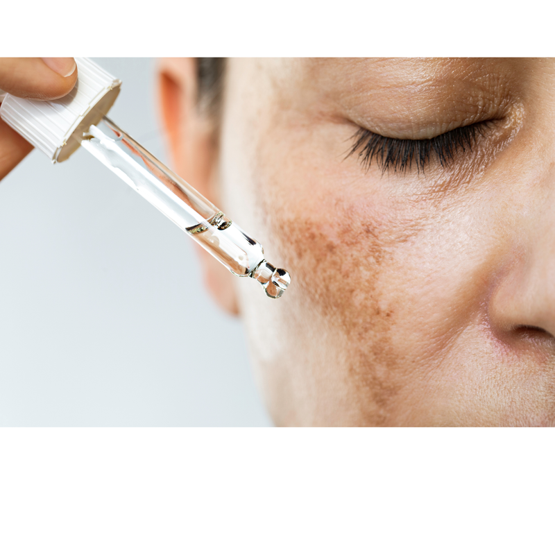 Protocolo para Melasma