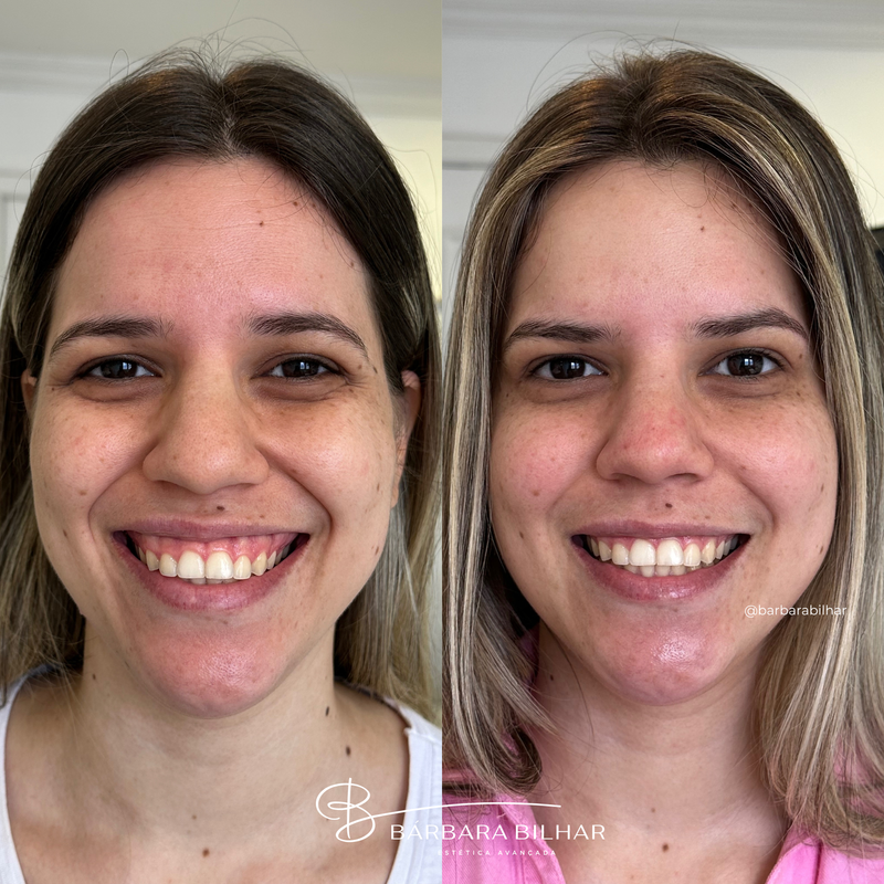 Toxina Botulínica para Sorriso gengival