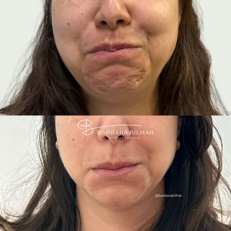 Toxina Botulínica para Queixo ("queixo celulítico")