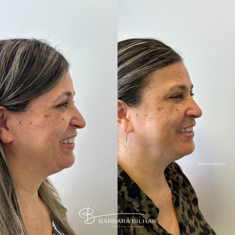 Toxina Botulínica para Elevação da ponta do nariz