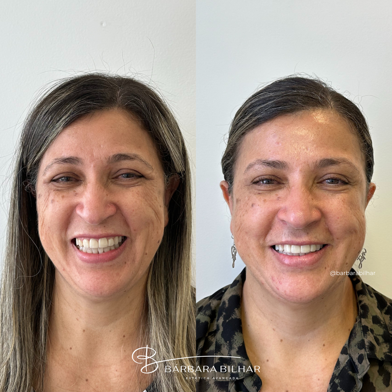 Toxina Botulínica para Elevação da ponta do nariz