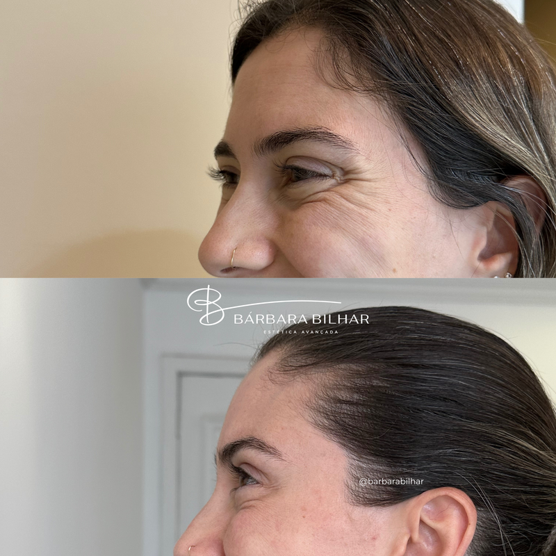 Toxina Botulínica para Rugas da região dos olhos ("pés de galinha")