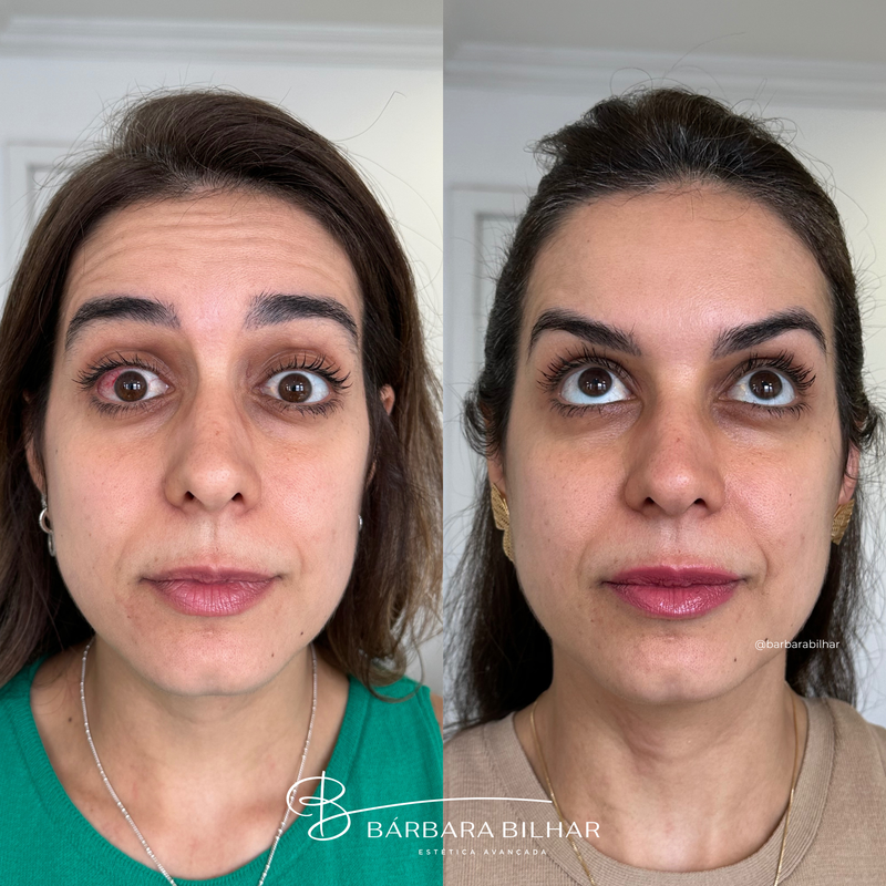 Toxina Botulínica para Rugas da testa