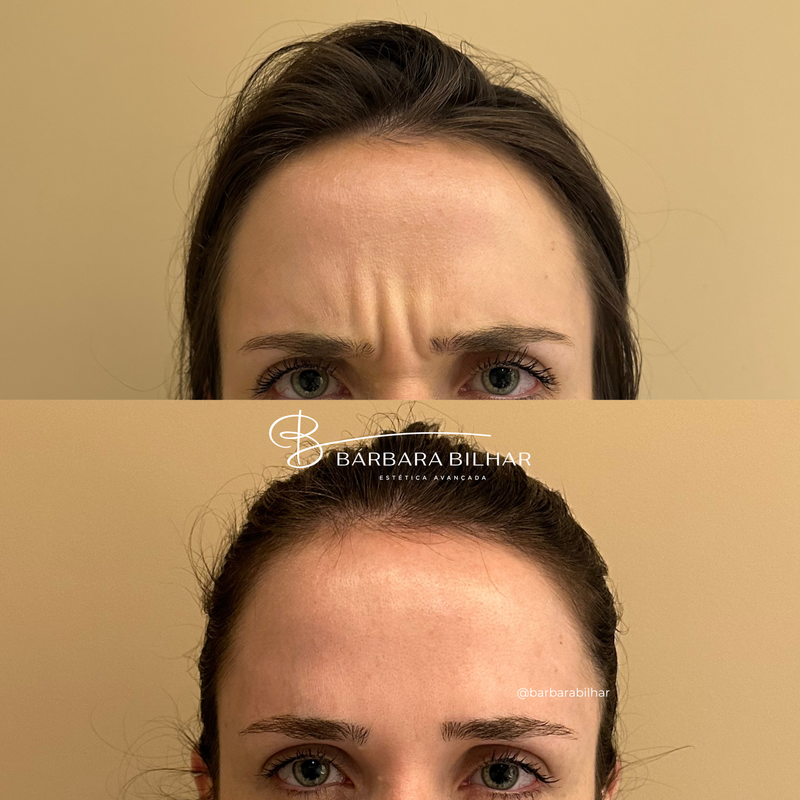 Toxina Botulínica para Rugas da glabela ("ruga de bravo")