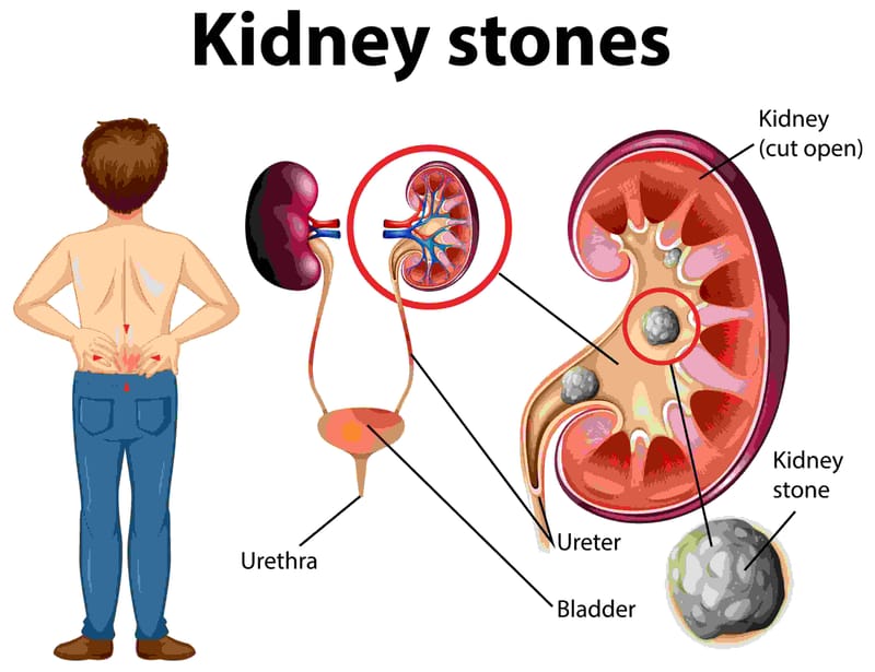What Is the Best Kidney Stone Treatment ?