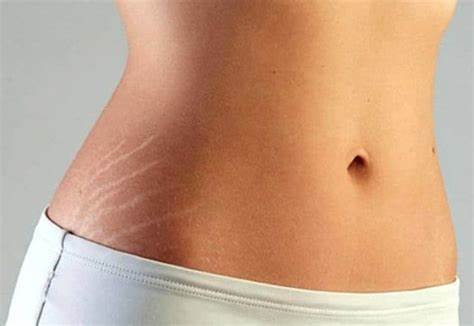 STRETCH MARK TREATMENT