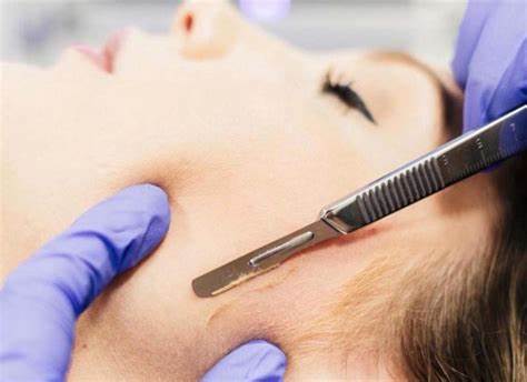 DERMAPLANING