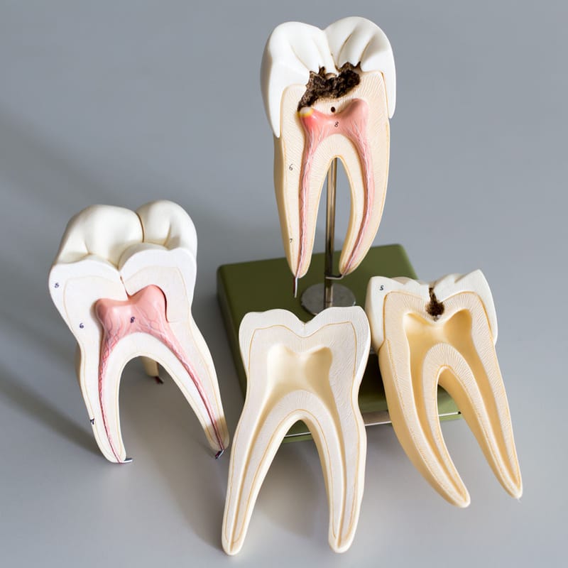 ROOT CANAL