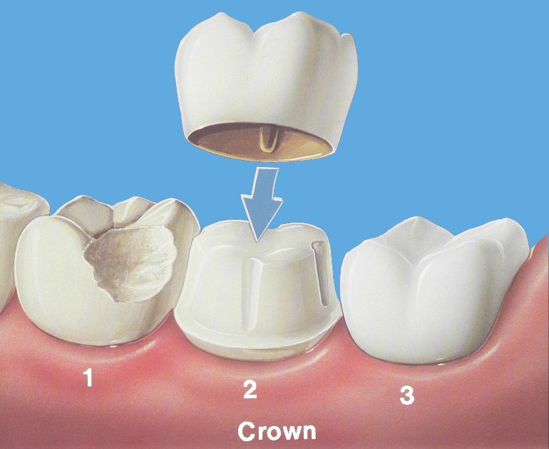 FILLINGS AND CROWN