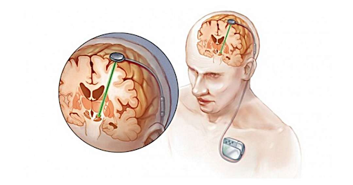 Những phát triển nghiên cứu mới về bệnh Parkinson: Phương pháp điều trị đầy hứa hẹn