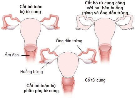 Phòng ngừa bệnh sa tử cung cho phụ nữ trẻ