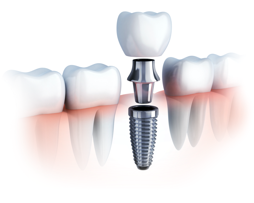 The Benefits of Dental Implantation