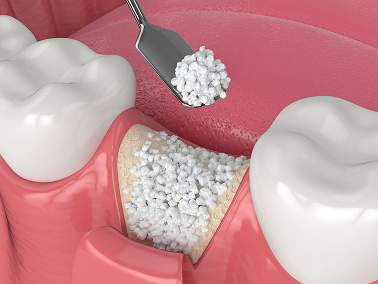 Bone grafting