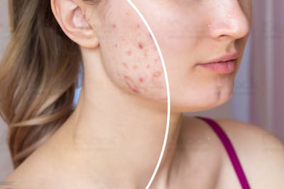 The Role of Face Wash in reducing acne and breakouts