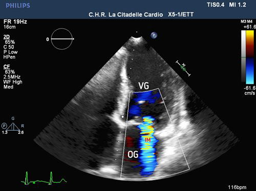 Échocardiographie-doppler transthoracique (ETT)