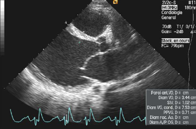 Échographie cardiaque