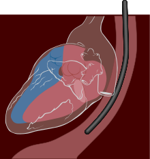 Échocardiographie-doppler transœsophagienne ( ETO)